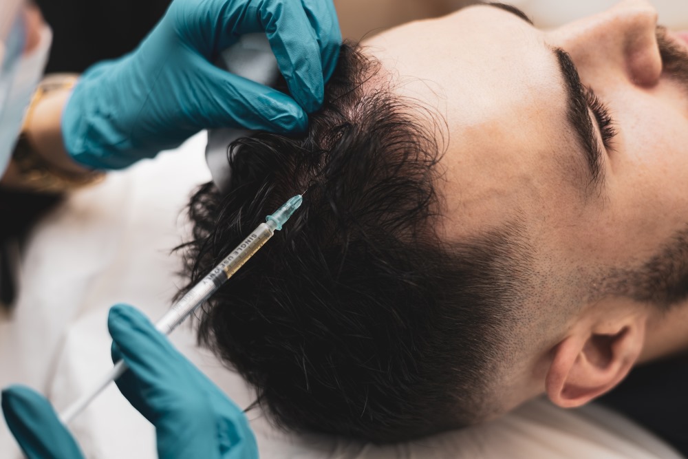 How Long Do the Results of PRP Hair Restoration Treatments Last?